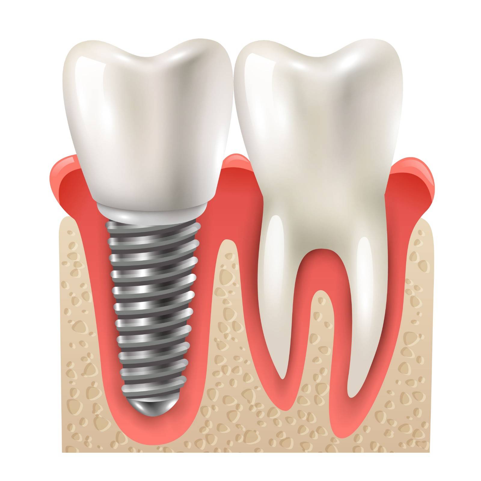dentist-implants-in-karuppayurani-madurai